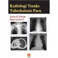 Radiologi Toraks Tuberkulosis Paru (4)