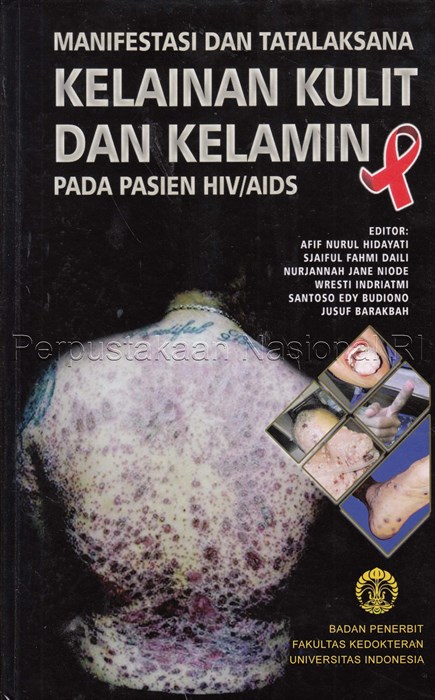 Manifestasi & Tatalaksana Kelainan Kulit & Kelamin Pada Pasien HIV/AIDS